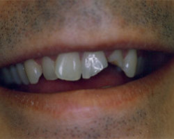 Tooth Colored Fittings Before and After at Brookdale Dental Group in Bloomfeild, NJ.