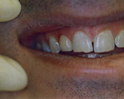 Tooth Colored Fittings Before and After at Brookdale Dental Group in Bloomfeild, NJ.