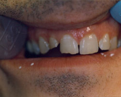 Tooth Colored Fittings Before and After at Brookdale Dental Group in Bloomfeild, NJ.