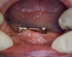 Dental Implants Before and After at Brookdale Dental Group in Bloomfeild, NJ.