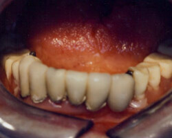 Dental Implants Before and After at Brookdale Dental Group in Bloomfeild, NJ.