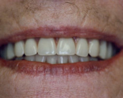 Dental Implants Before and After at Brookdale Dental Group in Bloomfeild, NJ.