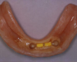 Dental Implants Before and After at Brookdale Dental Group in Bloomfeild, NJ.