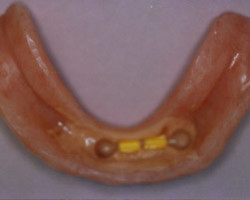 Dental Implants Before and After at Brookdale Dental Group in Bloomfeild, NJ.