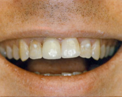 All Porcelain Dental Crowns Before and After at Brookdale Dental Group in Bloomfeild, NJ.