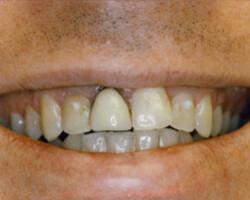 All Porcelain Dental Crowns Before and After at Brookdale Dental Group in Bloomfeild, NJ.