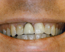 All Porcelain Dental Crowns Before and After at Brookdale Dental Group in Bloomfeild, NJ.