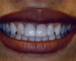 All Porcelain Dental Crowns Before and After at Brookdale Dental Group in Bloomfeild, NJ.