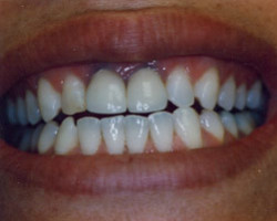 All Porcelain Dental Crowns Before and After at Brookdale Dental Group in Bloomfeild, NJ.