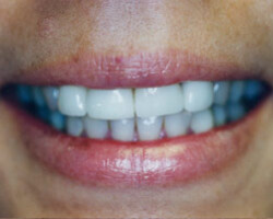 Dental Veneers Before and After at Brookdale Dental Group in Bloomfeild, NJ.