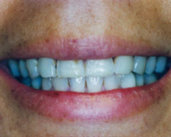 Dental Veneers Before and After at Brookdale Dental Group in Bloomfeild, NJ.