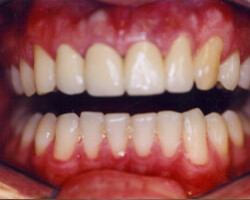 Dental Veneers Before and After at Brookdale Dental Group in Bloomfeild, NJ.