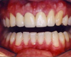 Dental Veneers Before and After at Brookdale Dental Group in Bloomfeild, NJ.