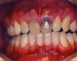 Dental Veneers Before and After at Brookdale Dental Group in Bloomfeild, NJ.