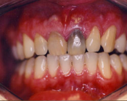 Dental Veneers Before and After at Brookdale Dental Group in Bloomfeild, NJ.