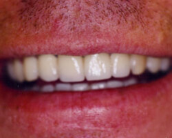 Dental Veneers Before and After at Brookdale Dental Group in Bloomfeild, NJ.