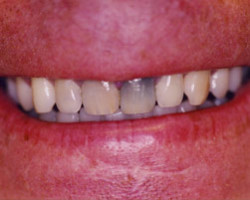 Dental Veneers Before and After at Brookdale Dental Group in Bloomfeild, NJ.