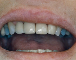 Dental Veneers Before and After at Brookdale Dental Group in Bloomfeild, NJ.