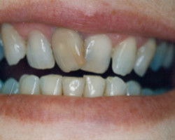 Dental Veneers Before and After at Brookdale Dental Group in Bloomfeild, NJ.