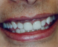 Dental Veneers Before and After at Brookdale Dental Group in Bloomfeild, NJ.