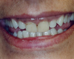 Dental Veneers Before and After at Brookdale Dental Group in Bloomfeild, NJ.