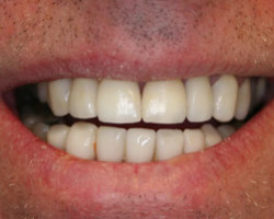 Dental Veneers Before and After at Brookdale Dental Group in Bloomfeild, NJ.
