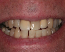 Dental Veneers Before and After at Brookdale Dental Group in Bloomfeild, NJ.