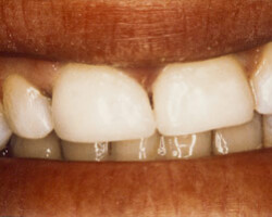 Dental Veneers Before and After at Brookdale Dental Group in Bloomfeild, NJ.
