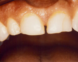 Dental Veneers Before and After at Brookdale Dental Group in Bloomfeild, NJ.