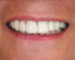 Dental Veneers Before and After at Brookdale Dental Group in Bloomfeild, NJ.