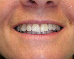Dental Veneers Before and After at Brookdale Dental Group in Bloomfeild, NJ.